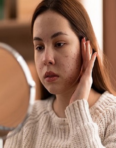 Acne Scar Treatment