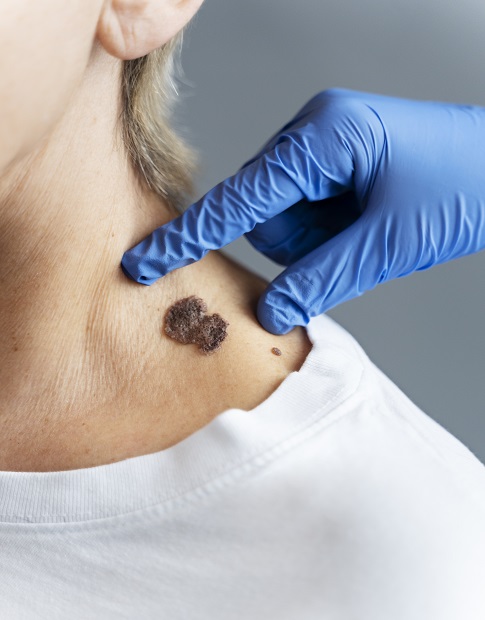 Mole Removal